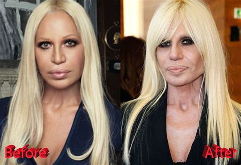 donatella versace e sposata ed ha figli|donatella versace before and after surgery.